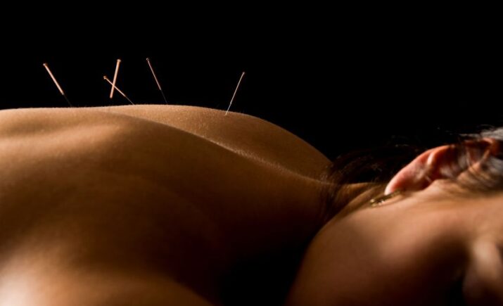 Acupuncture